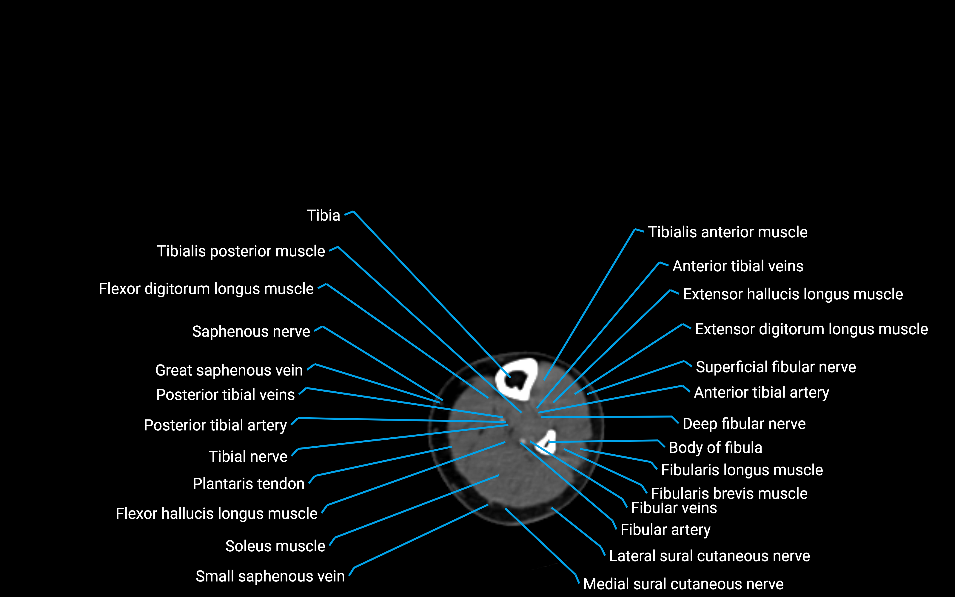 CT Lower leg axial cross sectional anatomy labelled image 125 (2).png